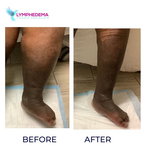 Lymphedema Treatment