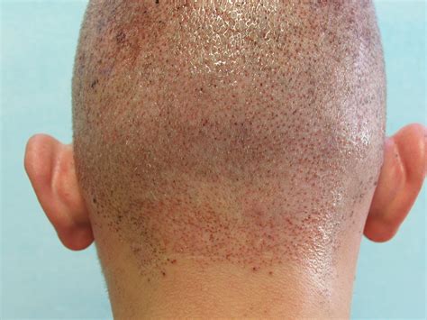 Cure against baldness: FUE Hair Transplant Surgery