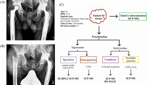 (A) A loosened cup of the left total hip arthroplasty in an 81‐year‐old ...