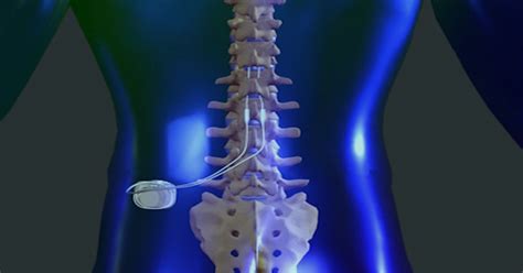 Medtronic Spinal Cord Stimulator Manual