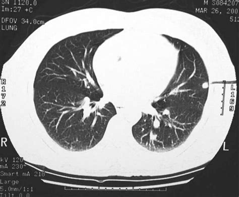 Calcified granuloma definition, causes, symptoms, diagnosis & treatment