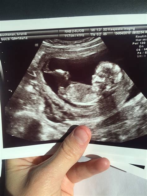 How accurate is my girl gender prediction at 13 weeks 5 days pictures included