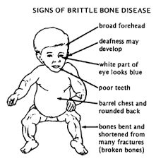 brittle bone – Best Physiotherapy Center in Bengaluru