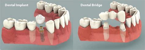 Dental Bridges Vs Implants