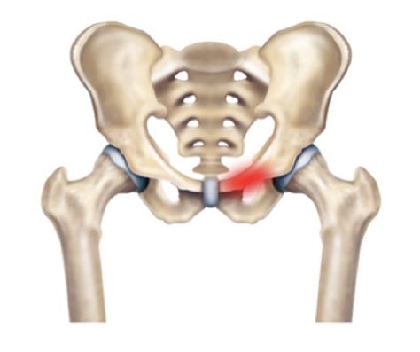 Groin and hip pain could it be Osteitis Pubis Chiropractic Care Centre ...