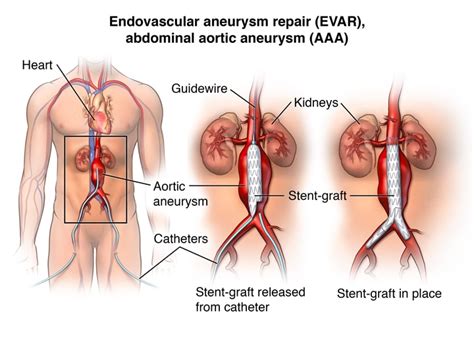 Vascular Surgery & Interventions