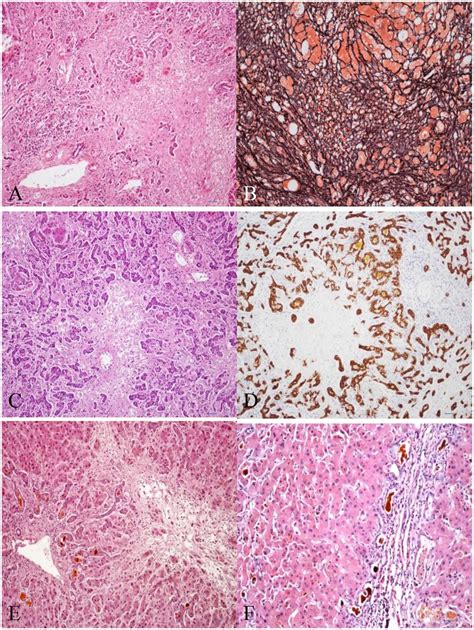 (A) Massive hepatic necrosis, liver cell dropout, residual hepatocytes... | Download Scientific ...