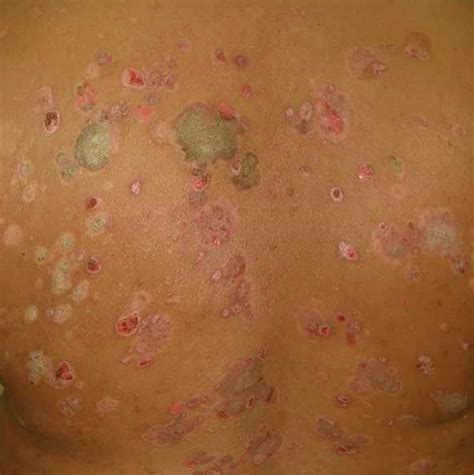 Bullous Pemphigoid - Pictures, Treatment, Symptoms, Prognosis, Diagnosis