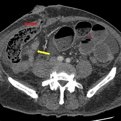 CECT post laparoscopic anterior resection and loop ileostomy. Dilated,... | Download Scientific ...