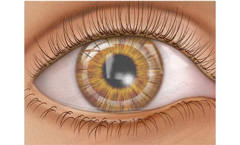 Penetrating keratoplasty post-op with sutures - SUCO0004 - Stock eye images