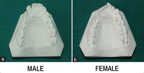 Palatal rugae pattern in males and females | Download Scientific Diagram