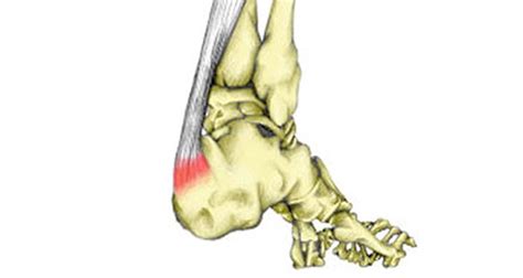 Insertional Achilles Tendonitis - Symptoms, Causes, Treatment & Rehab