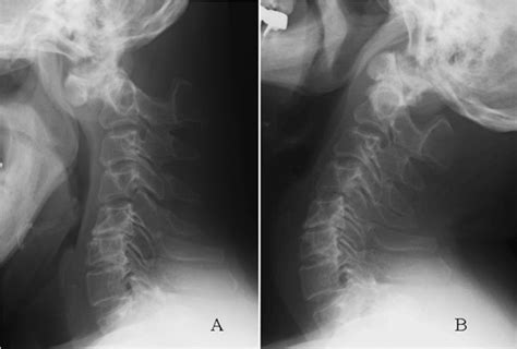 Atlantoaxial Instability