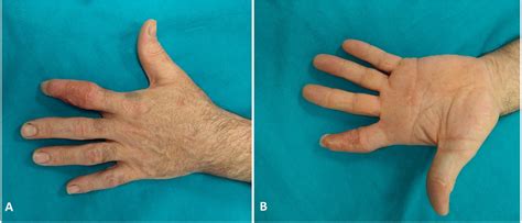 Treatment of finger degloving injury with acellular dermal matrices ...