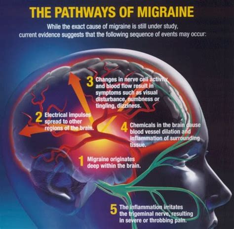 Migraine | MyBrainTest