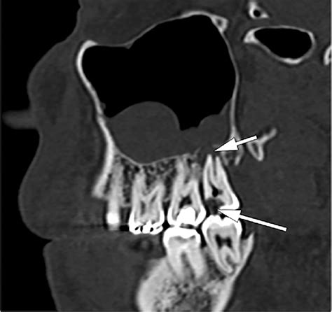 Odontogenic sinusitis. Oblique sagittal CT image shows mucosal... | Download Scientific Diagram