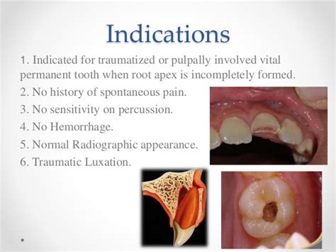 Apexogenesis & apexification in pediatric dentistry