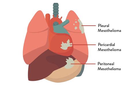 Malignant Pleural Mesothelioma Survival Rate - Mesothelioma