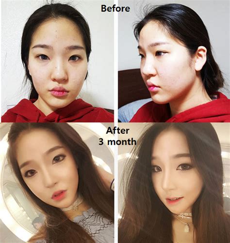 V line surgery results! | Laser hair, Laser hair removal, Facial plastic surgery