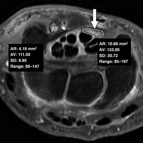 MRI of the Carpal Tunnel 3 and 12 Months After Endoscopic Carpal Tunnel ...