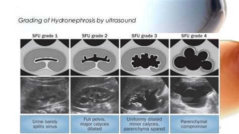 Obstructive uropathy