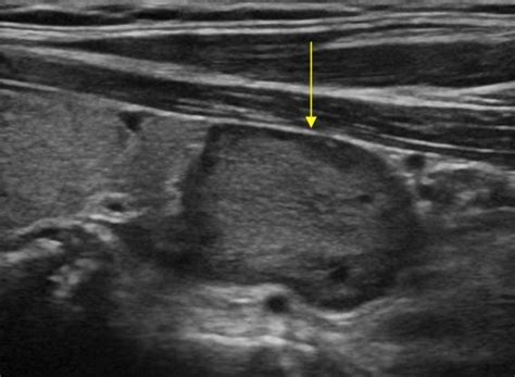 Head and Neck | 4.2 Parathyroid glands : Case 4.2.1 Parathyroids | Ultrasound Cases