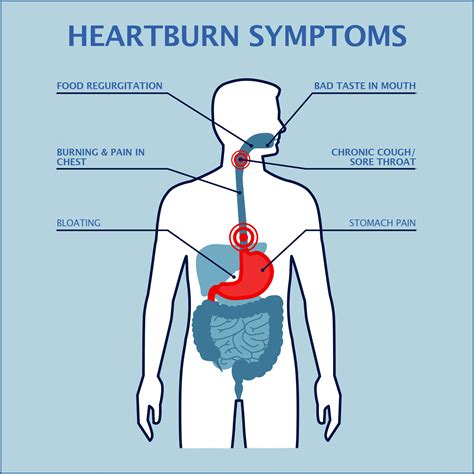 Heartburn-Graphics-min | Gastroenterology of Greater Orlando