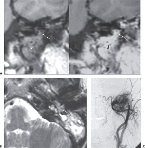 Paraganglioma | Radiology Key