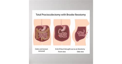 Total proctocolectomy with Brooke ileostomy poster | Zazzle