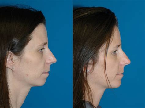 Chin Implant Seattle | Chin Augmentation | Genioplasty