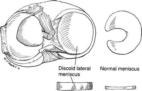 Discoid Meniscus - Children's Bone and Spine Surgery