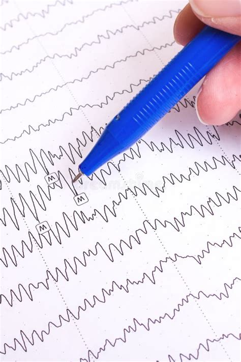 Results of Electroencephalogram on Paper, Diagnostics of Epilepsy Stock ...