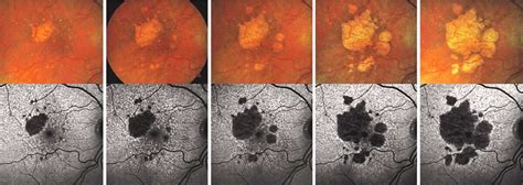 Syfovre: Dry Macular Degeneration Treatment in Venice FL