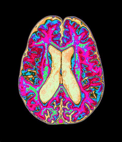 Coloured Mri Scan Of Organophosphate Brain Damage Photograph by Mehau ...