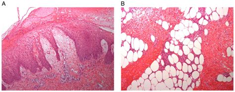 Recombinant human soluble thrombomodulin and danaparoid combination anticoagulant therapy for ...