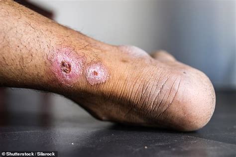 ‘I was really worried I might lose my limb’: Flesh eating ulcer infecting hundreds of Aussies ...