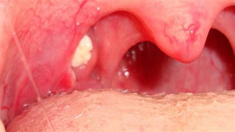 Tonsil Stones! AKA Tonsilloliths - YouTube