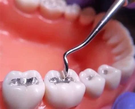 Dental Amalgam Is It Harmless or Not? - Doctor Monther Numan Dental Clinic