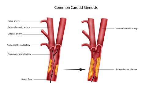 Pathophysiology | Stenosis, Carotid artery, Superior thyroid artery