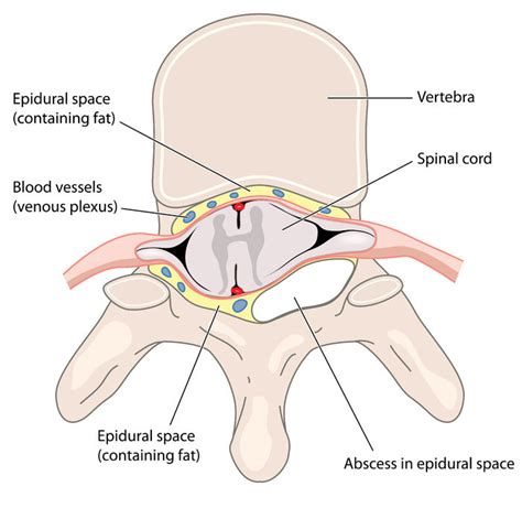 Spinal Infection: Epidural Abscesses