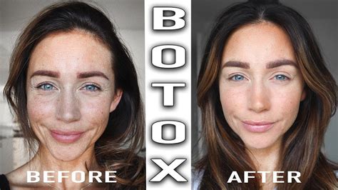 Botox Before And After