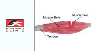 The Four Mistakes You Can Make After A Muscle Tear - Action Sports Clinic