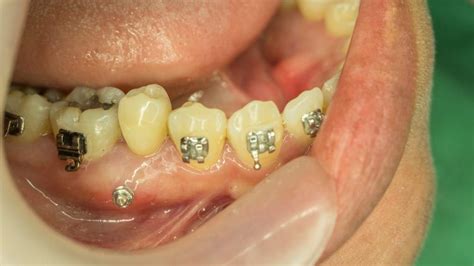 Mini-Dental Implants Are Your Restoration Option At Dentistry of Miami