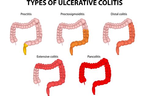 Colitis - Signature Health Services