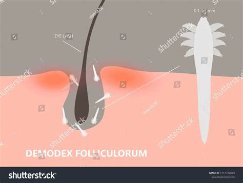 Demodex Eyelash Mites