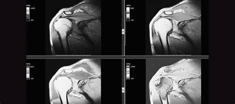 Shoulder MRI | I-MED Radiology Network