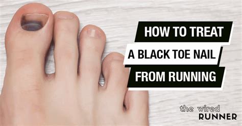 How to Treat a Bruised or Black Toenail from Running - The Wired Runner