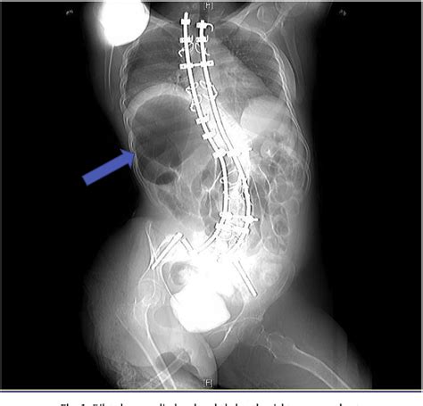 Figure 1 from Cecal volvulus with gangrene following Mitrofanoff ...