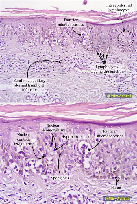 Mycosis Fungoides Histology