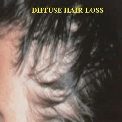 Diffuse Hair Loss Treatment Services in New Delhi | ID: 6972555097